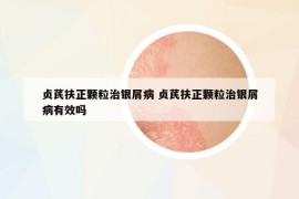 贞芪扶正颗粒治银屑病 贞芪扶正颗粒治银屑病有效吗