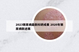2023银屑病最新科研成果 2020年银屑病新进展