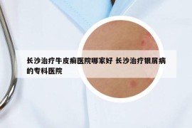 长沙治疗牛皮癣医院哪家好 长沙治疗银屑病的专科医院
