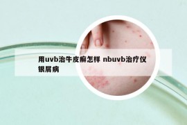 用uvb治牛皮癣怎样 nbuvb治疗仪 银屑病