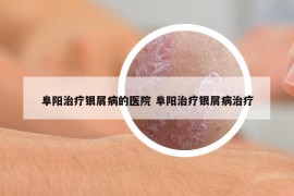 阜阳治疗银屑病的医院 阜阳治疗银屑病治疗