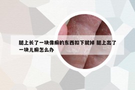 腿上长了一块像癣的东西扣下就掉 腿上出了一块儿癣怎么办