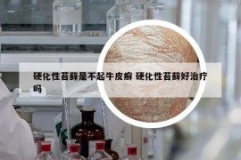 硬化性苔藓是不起牛皮癣 硬化性苔藓好治疗吗