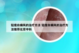 轻度白癞风的治疗方法 轻度白癞风的治疗方法推荐北京中科