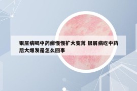 银屑病喝中药癣慢慢扩大变薄 银屑病吃中药后大爆发是怎么回事