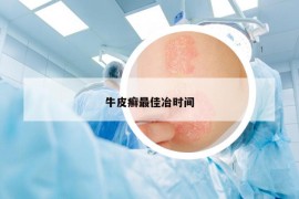 牛皮癣最佳冶时间