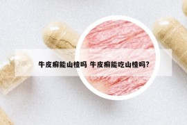 牛皮癣能山楂吗 牛皮癣能吃山楂吗?