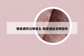 银屑病可以喝茶么 银屑病适合喝茶吗
