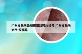 广州皮肤防治所恒福路预约挂号 广州皮肤防治所 恒福路