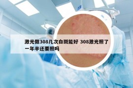 激光做308几次白斑能好 308激光照了一年半还要照吗