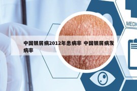 中国银屑病2012年患病率 中国银屑病发病率