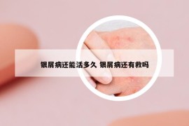 银屑病还能活多久 银屑病还有救吗