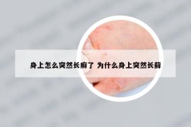 身上怎么突然长癣了 为什么身上突然长藓