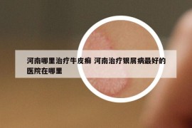 河南哪里治疗牛皮癣 河南治疗银屑病最好的医院在哪里