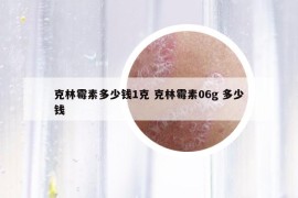克林霉素多少钱1克 克林霉素06g 多少钱