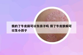 我的了牛皮藓可以生孩子吗 得了牛皮肤癣可以生小孩子