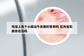 淘宝上有个小麻治牛皮癣的管用吗 在淘宝买麻膏犯法吗