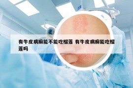 有牛皮病癣能不能吃榴莲 有牛皮病癣能吃榴莲吗