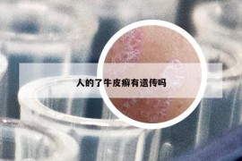 人的了牛皮癣有遗传吗
