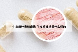 牛皮癣种类和症状 牛皮癣症状是什么样的