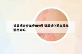 银屑病会查血查HIV吗 银屑病化验血能化验出来吗