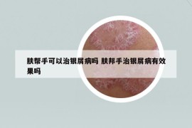 肤帮手可以治银屑病吗 肤邦手治银屑病有效果吗