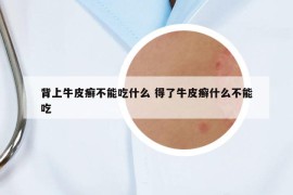 背上牛皮癣不能吃什么 得了牛皮癣什么不能吃
