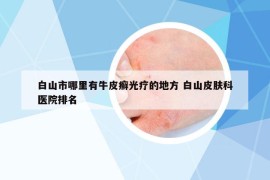 白山市哪里有牛皮癣光疗的地方 白山皮肤科医院排名