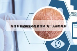 为什么会起癣是不是被传染 为什么会出现癣