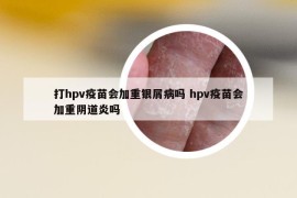 打hpv疫苗会加重银屑病吗 hpv疫苗会加重阴道炎吗