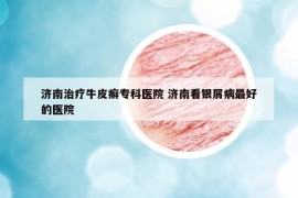 济南治疗牛皮癣专科医院 济南看银屑病最好的医院