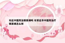 石庄中医院治银屑病吗 石家庄市中医院治疗银屑病怎么样