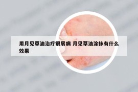 用月见草油治疗银屑病 月见草油涂抹有什么效果