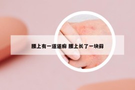 腰上有一道道癣 腰上长了一块藓