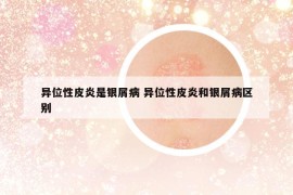 异位性皮炎是银屑病 异位性皮炎和银屑病区别