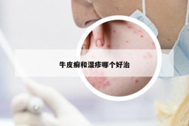 牛皮癣和湿疹哪个好治