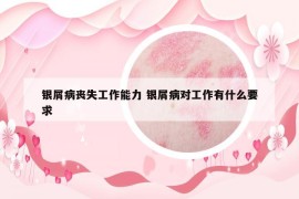 银屑病丧失工作能力 银屑病对工作有什么要求