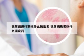 银屑病进行期吃什么抗生素 银屑病患者吃什么消炎药