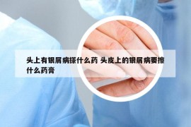头上有银屑病搽什么药 头皮上的银屑病要擦什么药膏