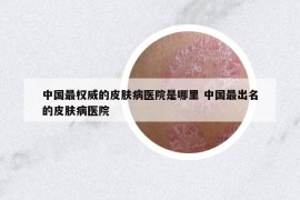 中国最权威的皮肤病医院是哪里 中国最出名的皮肤病医院