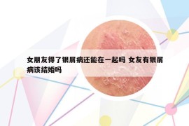 女朋友得了银屑病还能在一起吗 女友有银屑病该结婚吗