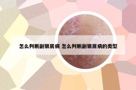 怎么判断副银屑病 怎么判断副银屑病的类型