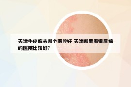 天津牛皮癣去哪个医院好 天津哪里看银屑病的医院比较好?
