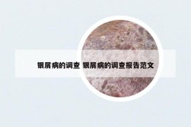 银屑病的调查 银屑病的调查报告范文