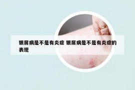 银屑病是不是有炎症 银屑病是不是有炎症的表现