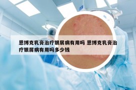 恩博克乳膏治疗银屑病有用吗 恩博克乳膏治疗银屑病有用吗多少钱