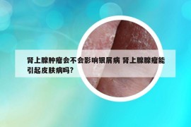 肾上腺肿瘤会不会影响银屑病 肾上腺腺瘤能引起皮肤病吗?