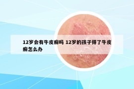 12岁会有牛皮癣吗 12岁的孩子得了牛皮癣怎么办