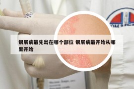 银屑病最先出在哪个部位 银屑病最开始从哪里开始