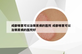成都哪里可以治银屑病的医院 成都哪里可以治银屑病的医院好
